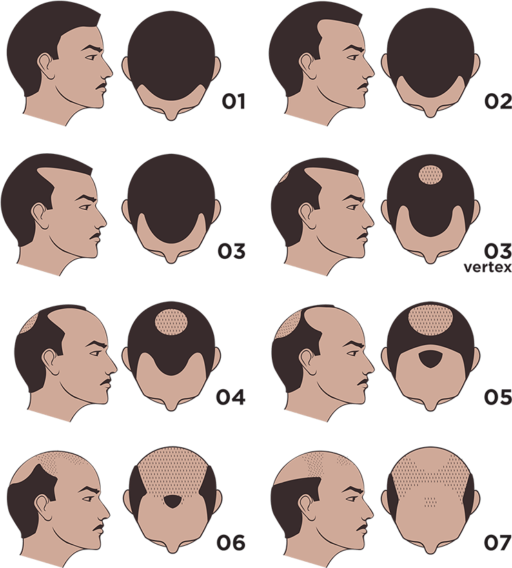Norwood Chart Pattern Baldness
